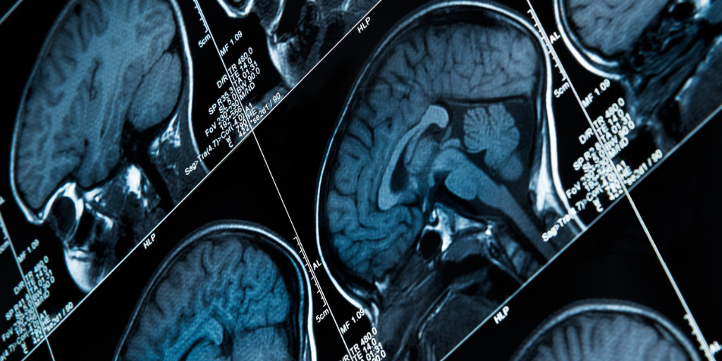Brain scan 